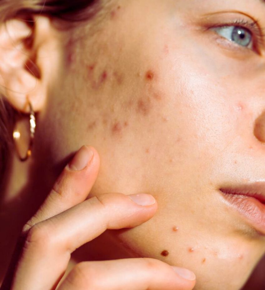درمان جوش صورت
