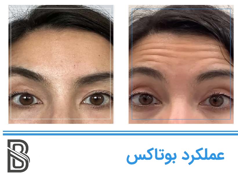 چه چینوچروکهایی با بوتاکس بهتر میشوند؟
