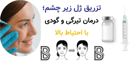 تزریق ژل زیر چشم؛ درمان تیرگی و گودی با احتیاط بالا