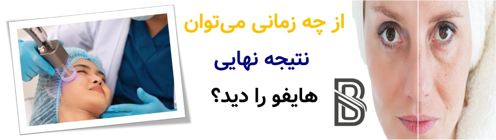 ماندگاری هایفو چقدر است و چند جلسه نیاز دارد؟ از چه زمانی میتوان نتیجه نهایی هایفو را دید؟