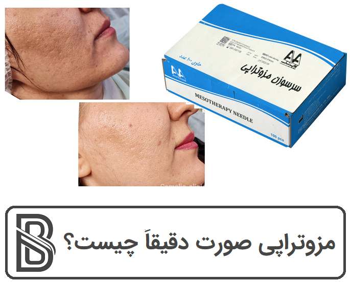 مزوتراپی صورت دقیقاً چیست؟