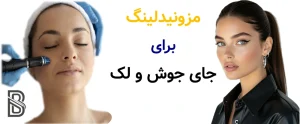 مزونیدلینگ برای جای جوش و لک.
