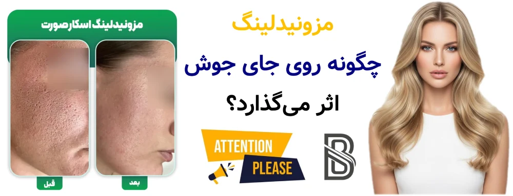 مزونیدلینگ برای جای جوش و لک، مزونیدلینگ چگونه روی جای جوش اثر میگذارد؟