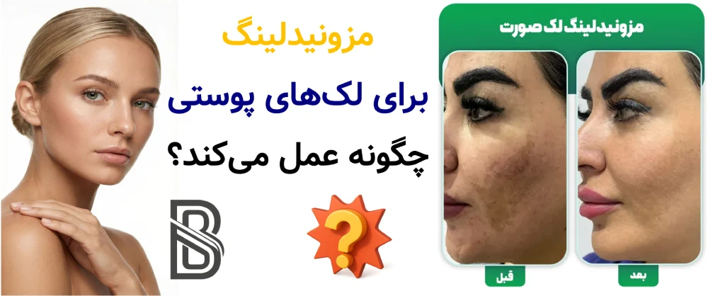 مزونیدلینگ برای جای جوش و لک ، مزونیدلینگ برای لکهای پوستی چگونه عمل میکند؟