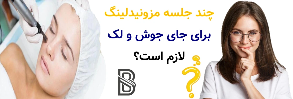 مزونیدلینگ برای جای جوش و لک، چند جلسه مزونیدلینگ برای جای جوش و لک لازم است؟
