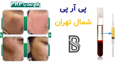 پی آر پی شمال تهران
